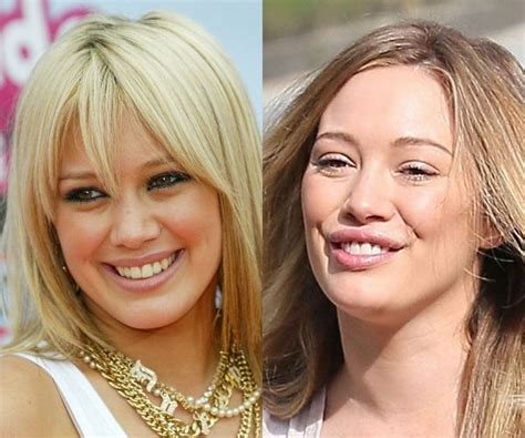 hilary duff face surgery